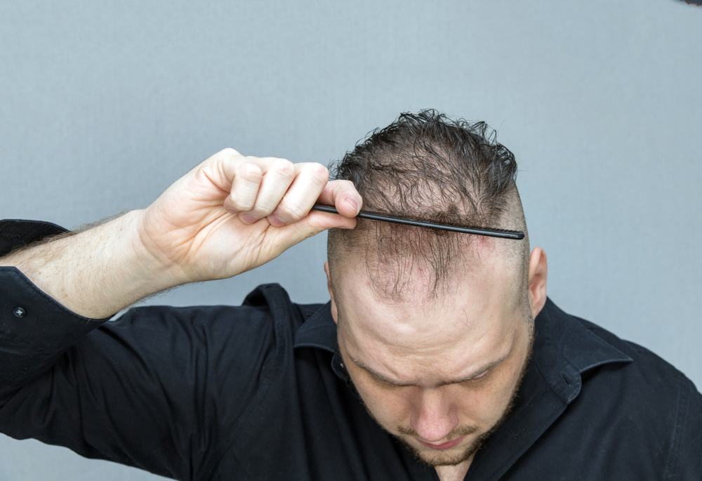 Injerto De Pelo T Cnica Fue O Fuss Cu L Es Mejor Capilea M Xico