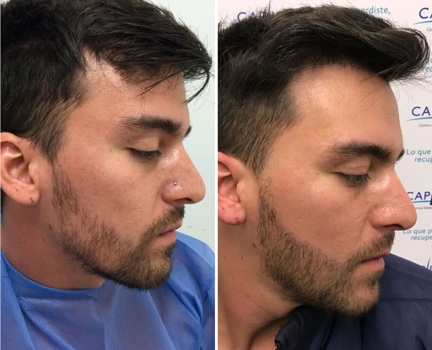 injerto de barba antes y despues