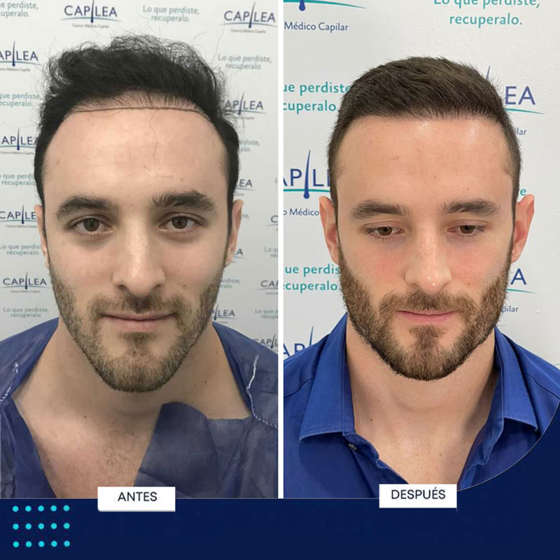 Hair transplant procedure: before and after