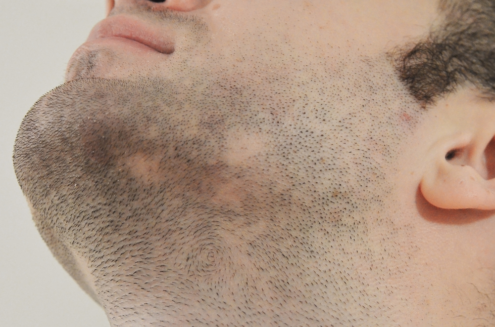Detail oriented facial hair transplant