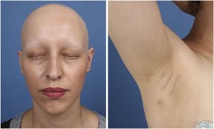 Alopecia areata universalis​