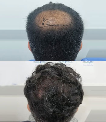 alopecia androgenica