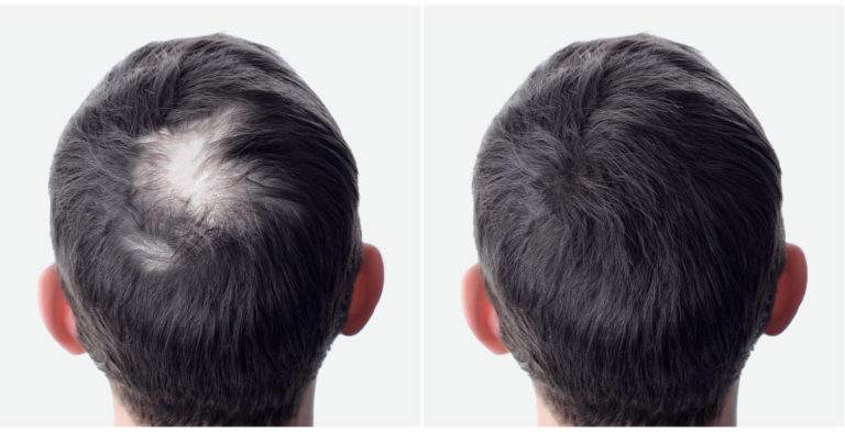 trasplante de cabello antes y después