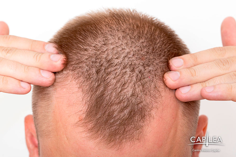 Las entradas de cabello forman una "V" en la cabeza, en la parte frontal.