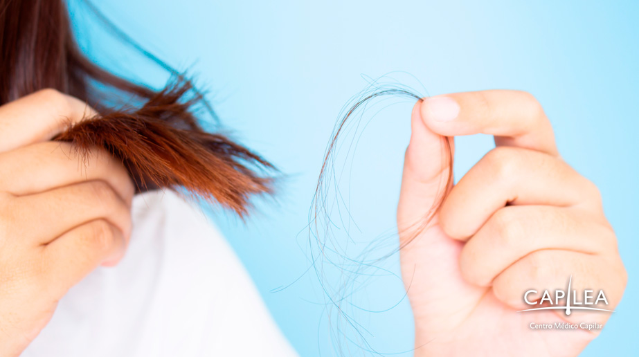 El problema de la pérdida de cabello puede comenzar desde la adolescencia. 