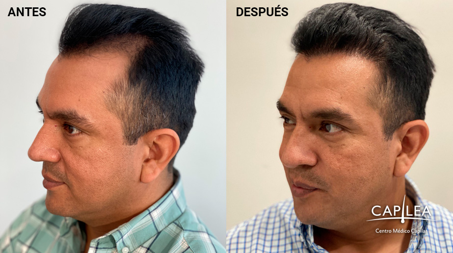 Can you get a hair transplant without shaving head