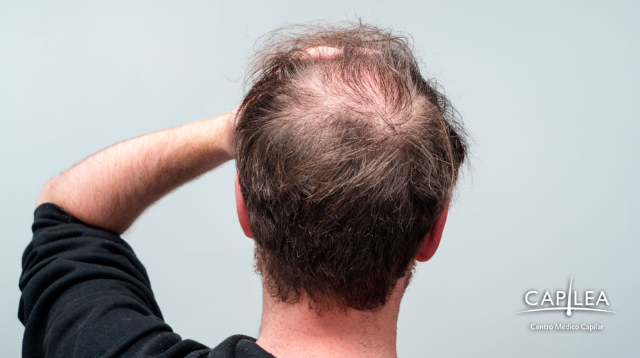 Dutasteride for hair loss
