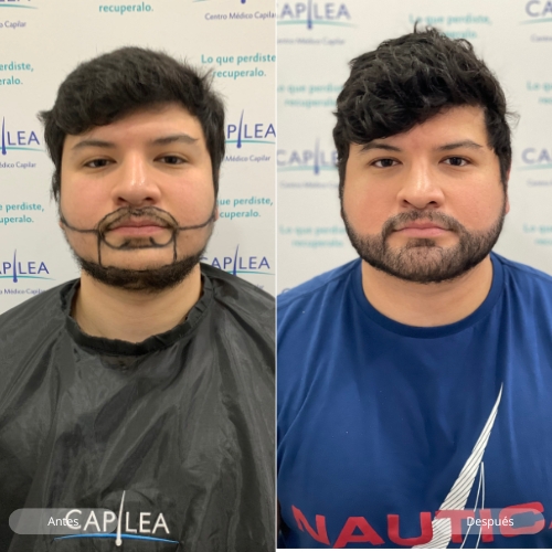 Beard transplant un mexico