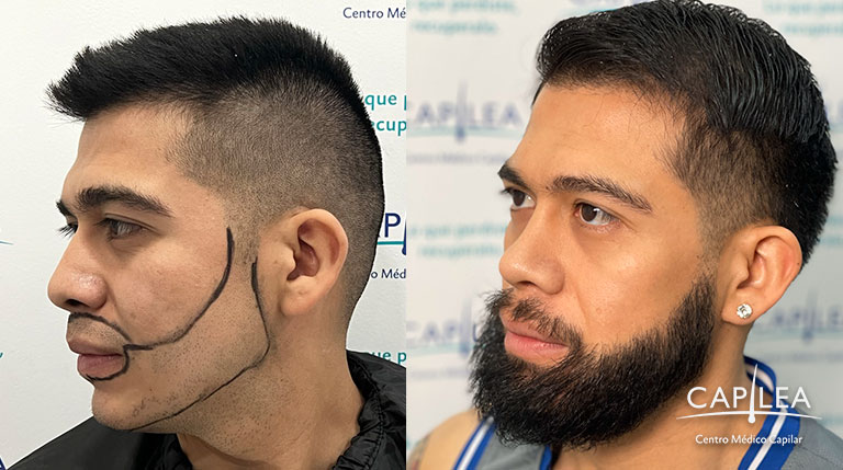 Paciente de injerto de barba de Capilea México.