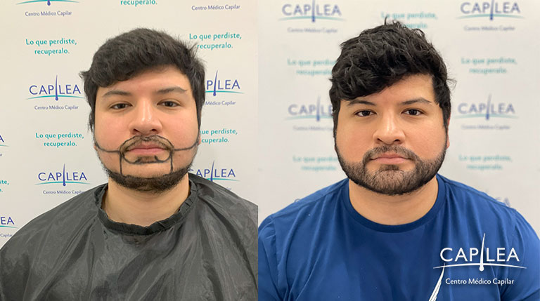Paciente de implante de barba en Capilea México.