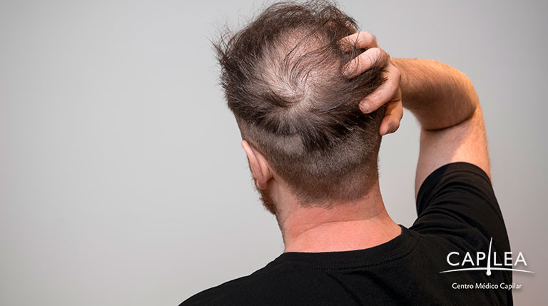 Crown and receding hairline are common areas of baldness. 