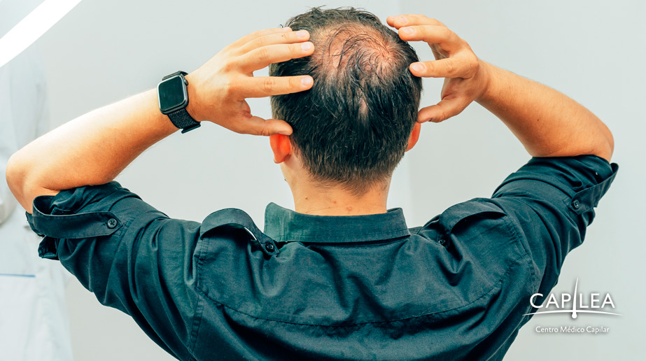 Hair loss affects thousands of people. 
