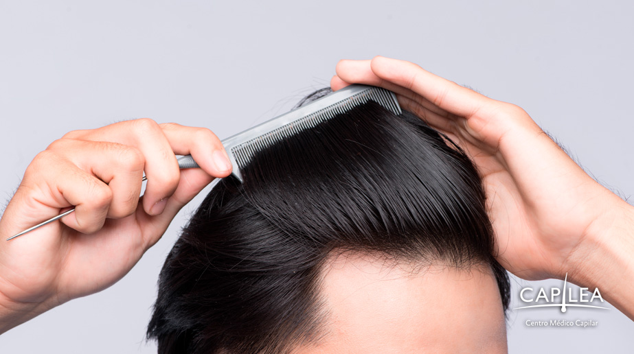 Hair transplants are a permanent solution to hair loss.