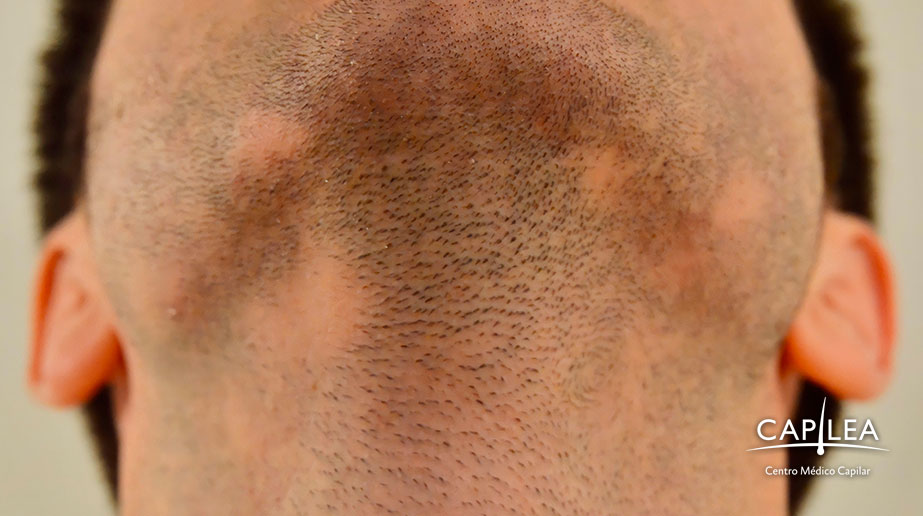 Alopecia barbae, or beard hair loss, is characterized by the appearance of hairless circles