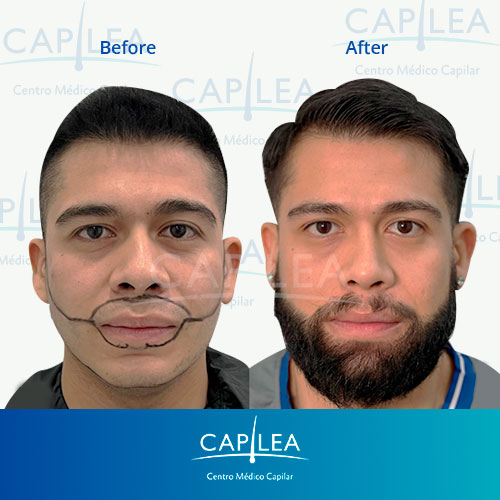 Before and after treating alopecia areata. 