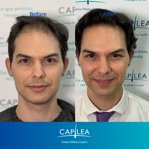 antes-y-despues-HECTOR