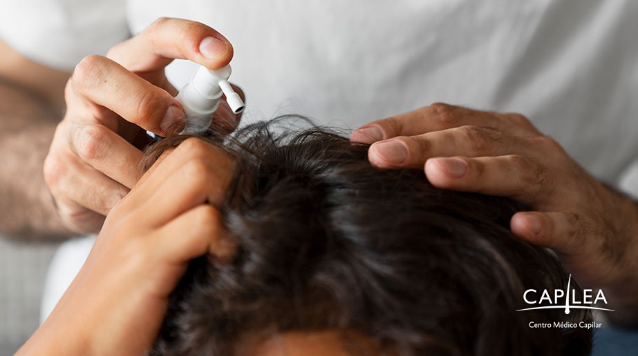 El uso del minoxidil se ha popularizado para estimular el crecimiento del cabello.