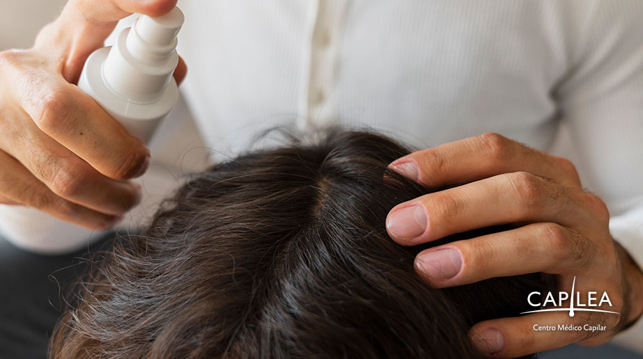 The use of minoxidil has become popular to stimulate hair growth.