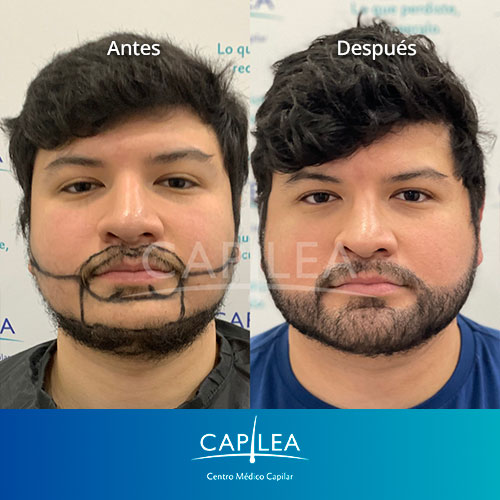 Capilea-testimonio-injerto