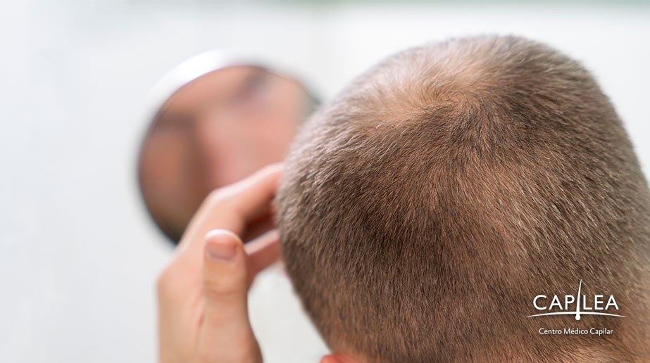 La alopecia androgénica y la alopecia areata son enfermedades que se pueden tratar en una clínica de alopecia. 