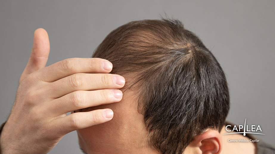 Elimina el DHT del cabello con un tratamiento personalizado en Capilea México.
