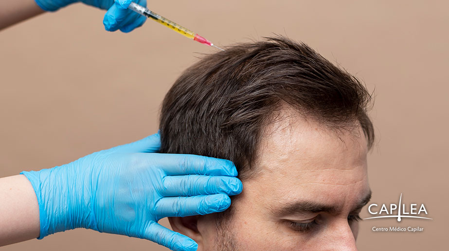 Eliminate DHT from your hair with a personalized treatment at Capilea Mexico.