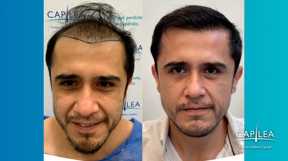 Capilea Mexico: before and after results. 