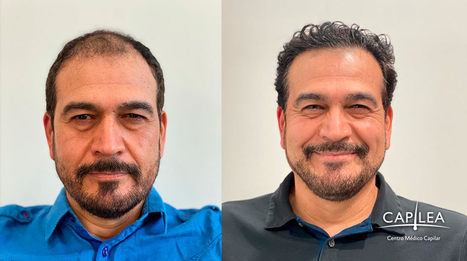 Capilea Mexico: before and after results.
