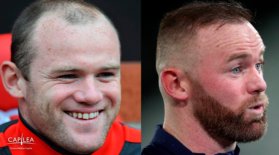 Hair transplant: before and after the procedure.
