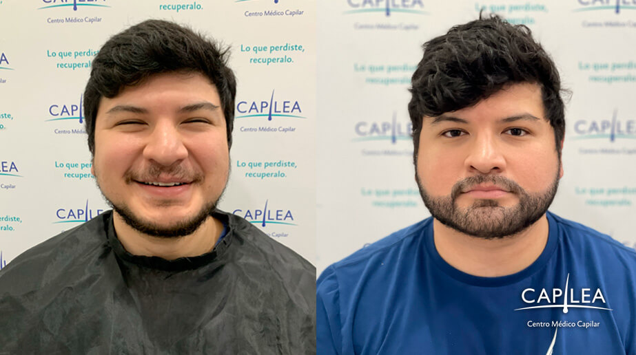 Beard transplant before and after at Capilea Mexico. 