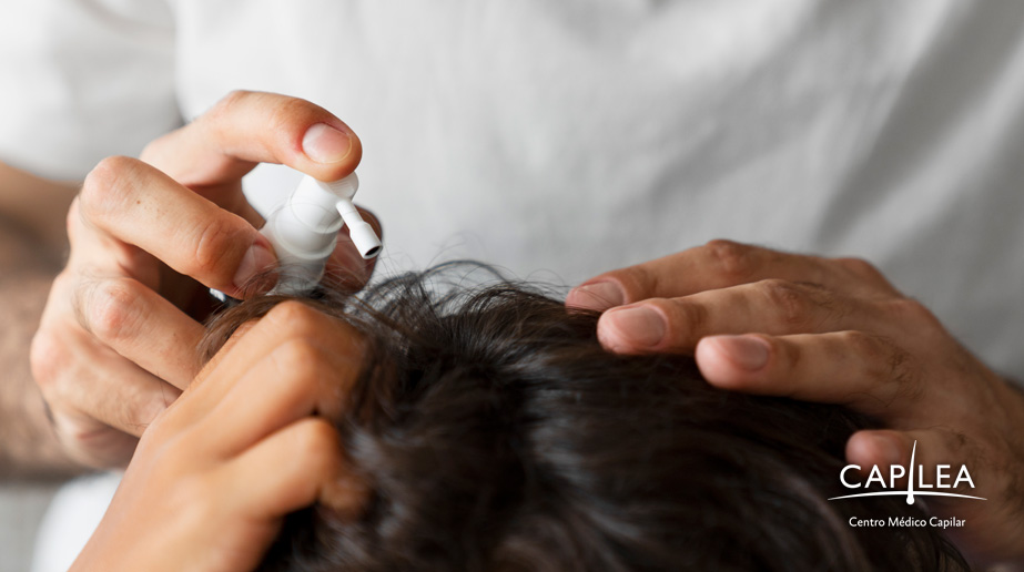 El tratamiento para la foliculitis decalvante consiste en controlar los síntomas y detener la progresión, no en erradicarla por completo.
